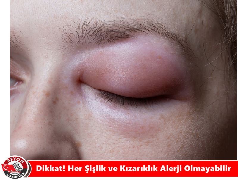 Dikkat! Her Sislik ve Kizariklik Alerji Olmayabilir